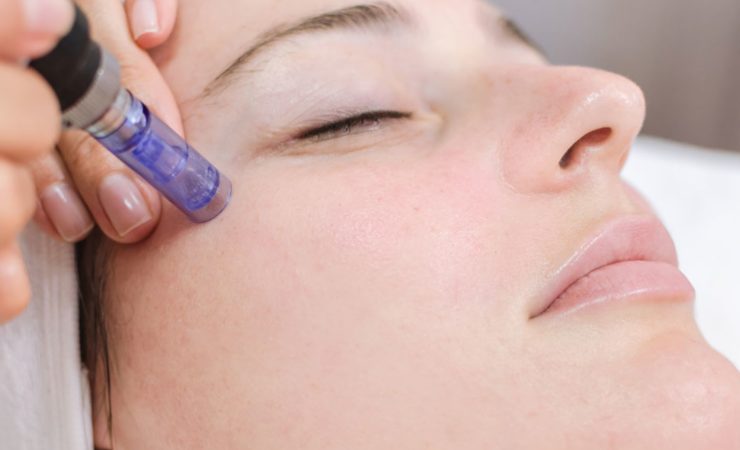 microneedling