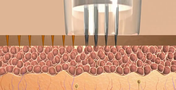 Microneedling
