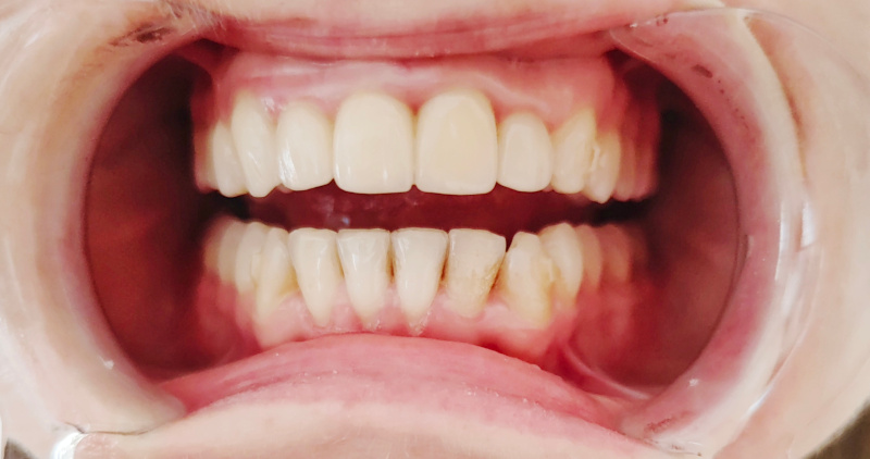 Active Aligners after - top jaw