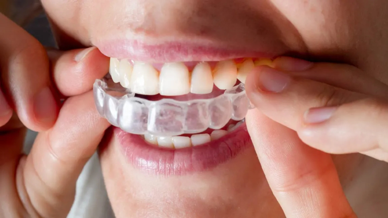 Active Aligners clear aligners review